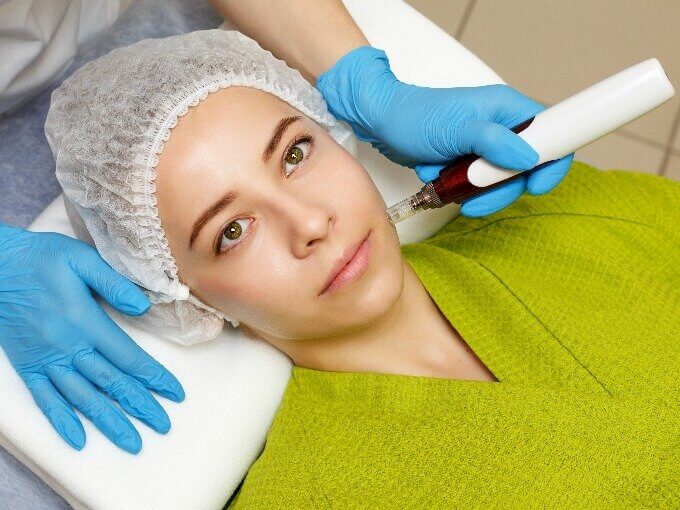Comment de déroule une séance de Microneedling ?